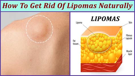 Lipoma Natural Treatment Simple Tips To Cure Lumps Naturally Urbanatural