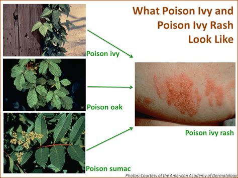 Get Rid Of Poison Ivy Rash