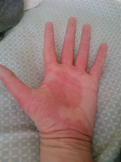 Right palm itching = you will receive some money very shortly. A Little Itchy: Day 123 (photos)