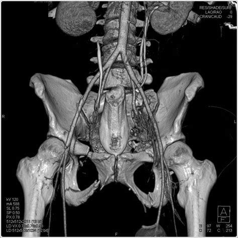 Hemoperitoneum Following Trauma With Open Wound Abdominal Wall And