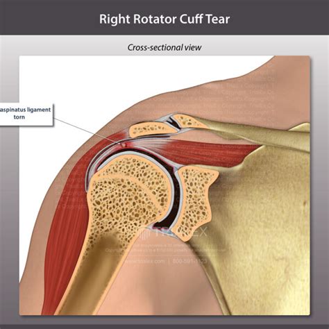 Right Rotator Cuff Tear Trialexhibits Inc