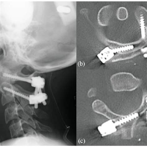 A Postoperative Lateral Radiographs Showing Good Reduction Of