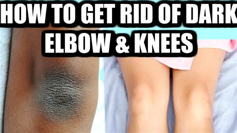 How To Get Rid Of Black Elbows And Knees Fast Superprincessjo Dark
