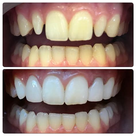 Cosmetic Dentistry Specialist Encino Before And Afters Cosmetic