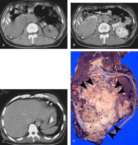 Collecting Duct Carcinoma Of The Kidney Ct And Pathologic Correlation