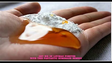Get Rid Of Lipomas Forever With This Fantastic Homemade Remedy Youtube