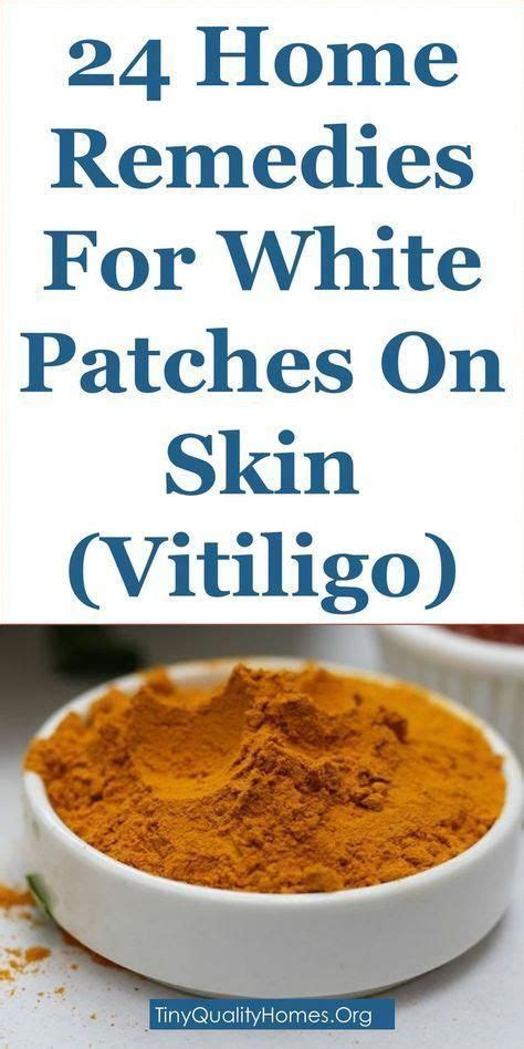 How To Treat White Spots On Skin