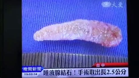 舌痛恐是結石惹的禍口腔唾液腺結石 徐偉軒牙醫師 Youtube