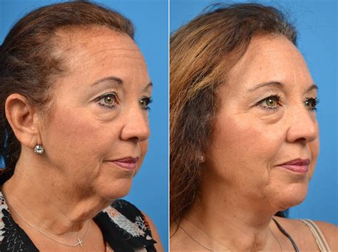 Patient 122406460 Laser Assisted Weekend Neck Lift Before And After
