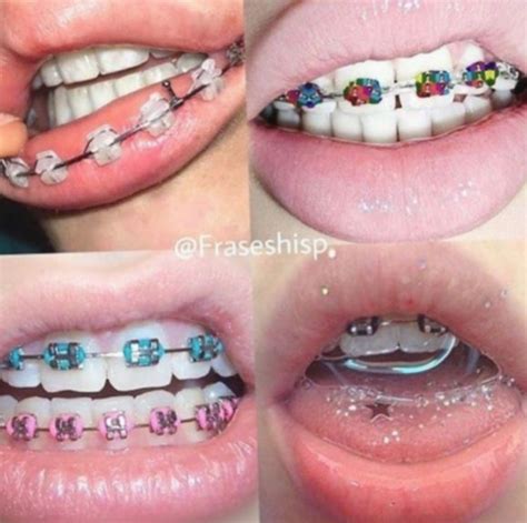 What Are The Cutest Colors For Braces Malisa Donohue