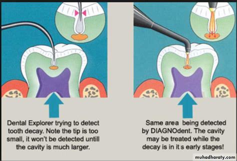Methods For Diagnosing Dental Caries How To Recognize Pathology