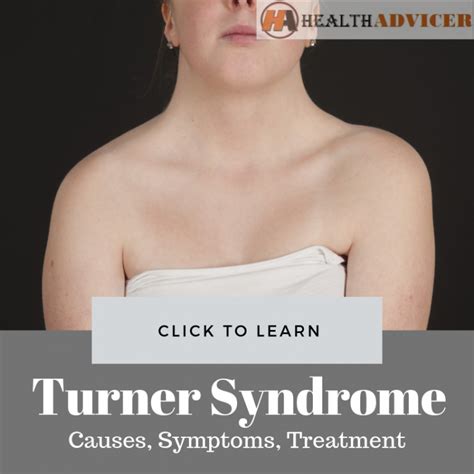 Turner Syndrome Pictures