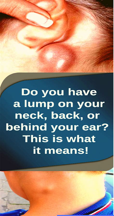 Do Youve A Lump On Your Neck Back Or Behind Your Ear