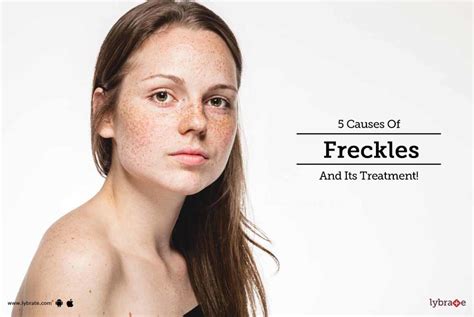 5 Causes Of Freckles And Its Treatment By Dr Sunil Sabhnani Lybrate
