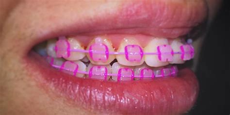 Pink Braces Braces Explained