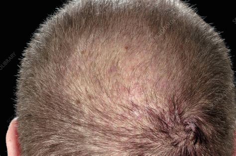 Folliculitis Of The Scalp Stock Image C0258048 Science Photo Library