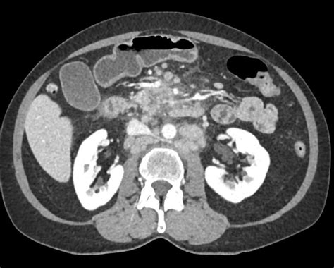 Lymphoma With Extensive Adenopathy Gastrointestinal Case Studies