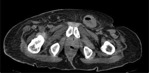 Elderly Male With Left Inguinal Hernia Ct Scan Of The Pelvis Shows A