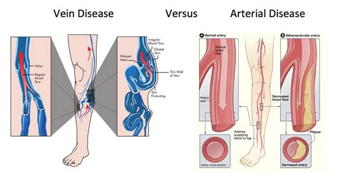 As a nursing student or nurse, you must be familiar with these types of ulcers. Vein Disease versus Arterial Disease