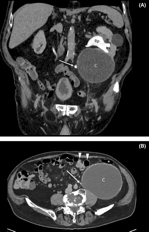 Coronal A And Axial B Contrast‐enhanced Ct Scan Obtained During