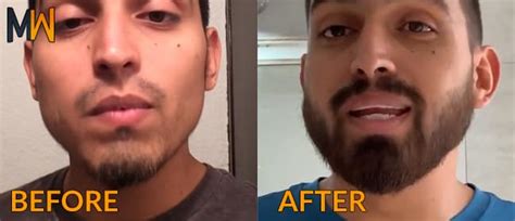 Their growth is more influenced by hormones like testosterone and dihydrotestosterone (dht) than but there isn't any research on this. Minoxidil Before And After Beard Result - 5 TIPS: Why Do I ...