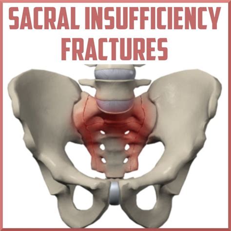 Sacral Insufficiency Fractures Sports Medicine Review Sports