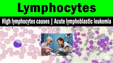 Lymphocytes High Lymphocytes Causes Acute Lymphoblastic Leukemia