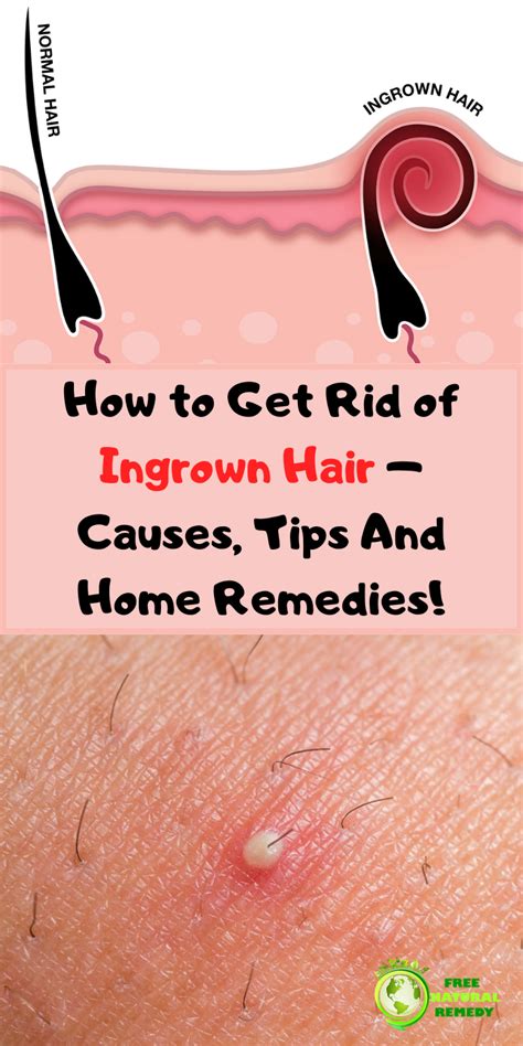 How To Treat Ingrown Hair Removal