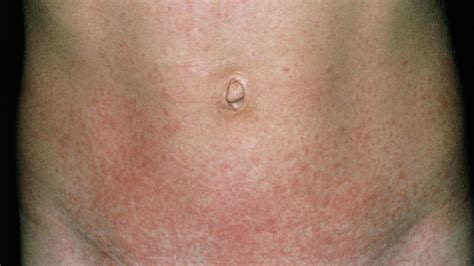 Scarlet Fever Cases Rise To Weekly High In England Bbc News