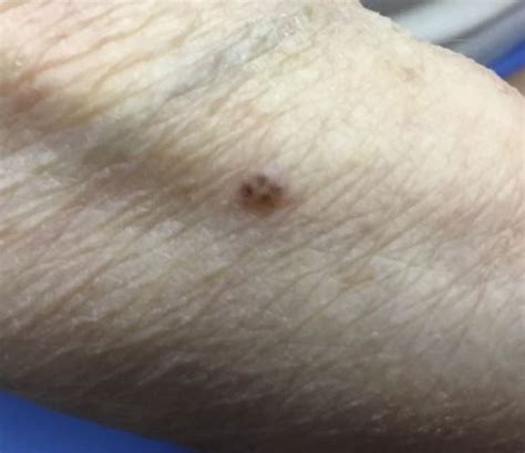 Derm Dx Flesh Colored Papule With Pigmented Speckles Clinical Advisor