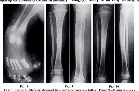 Figure 8 From The Aetiology Of Congenital Angulation Of Tubular Bones