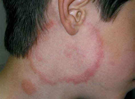 Familiarize Yourself With Tinea