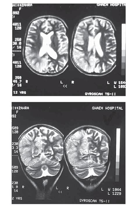 Brain Mri Of Patient Showing Diffuse Right Hemispheral Abnormal Signals