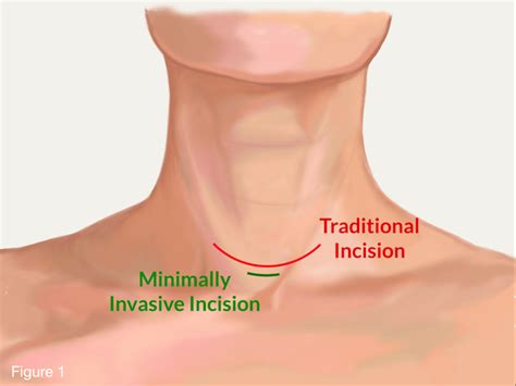 Minimally Invasive Parathyroidectomy