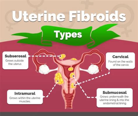 Uterine Fibroids Types Symptoms Treatments Infographi