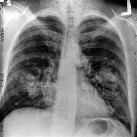 spots lung ray dark xray domain