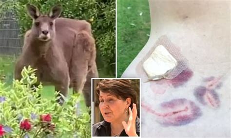 Woman Details Terrifying Moment She Was Savagely Attacked By A Massive Kangaroo In Her Own
