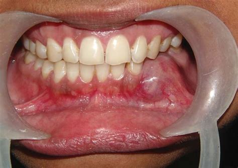 An Intraoral Photograph Shows A Dome Shaped Bluish Alveolar Swelling In