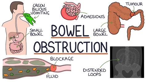 Understanding Bowel Obstruction Youtube