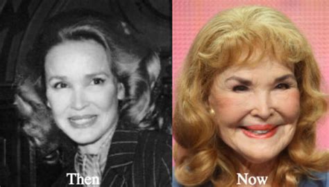 Kathryn Crosby Plastic Surgery Before And After Photos Latest Plastic Surgery Gossip And News
