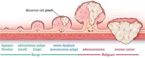 Colon Polyps Pictures Harcines