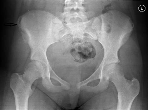 Iliac Crest Apophyseal Insufficiency Avulsion Fractures The Annals Of The Royal College Of