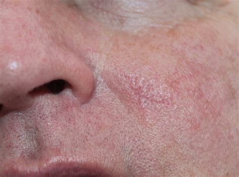 Close Up Scar After Skin Cancer Removal Left Cheek James Henderson