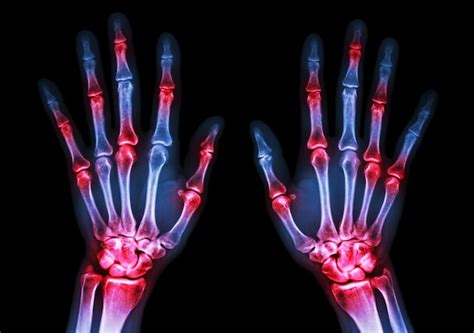 Premium Photo Rheumatoid Arthritis Film X Ray Both Hand Show