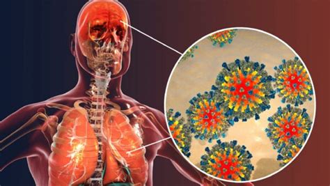 How Measles Impacts Your Immune System