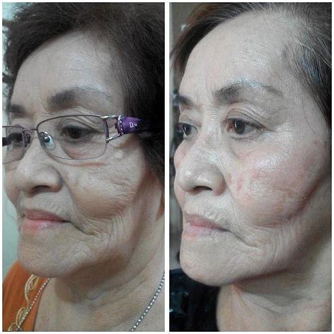 Thermage Before And After Photos Face 9 Facelift Info Prices