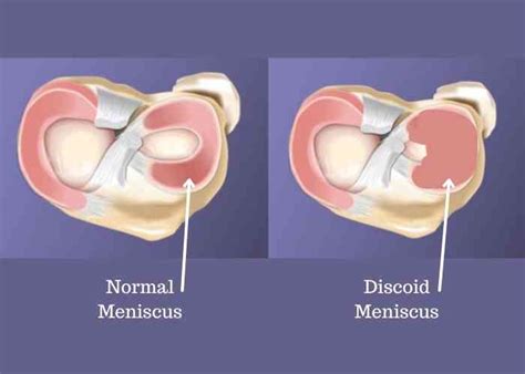 Discoid Meniscus Surgery Complex Knee Surgeon Minnesota