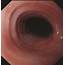 Simultaneous Contraction Rings In The Upper And Middle Esophagus 