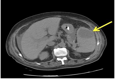 Splenic Abscess And Management Options Report Of Four Cases Al