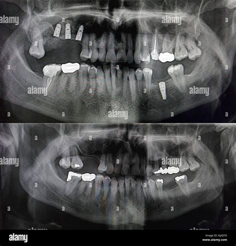 X Ray Showing Patients Teeth Before And After Placement Of Four Metal